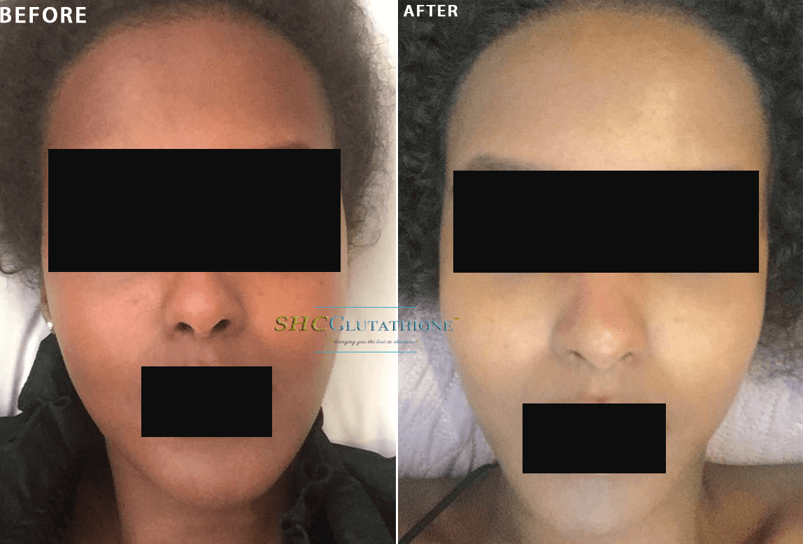 before and after glutathione results