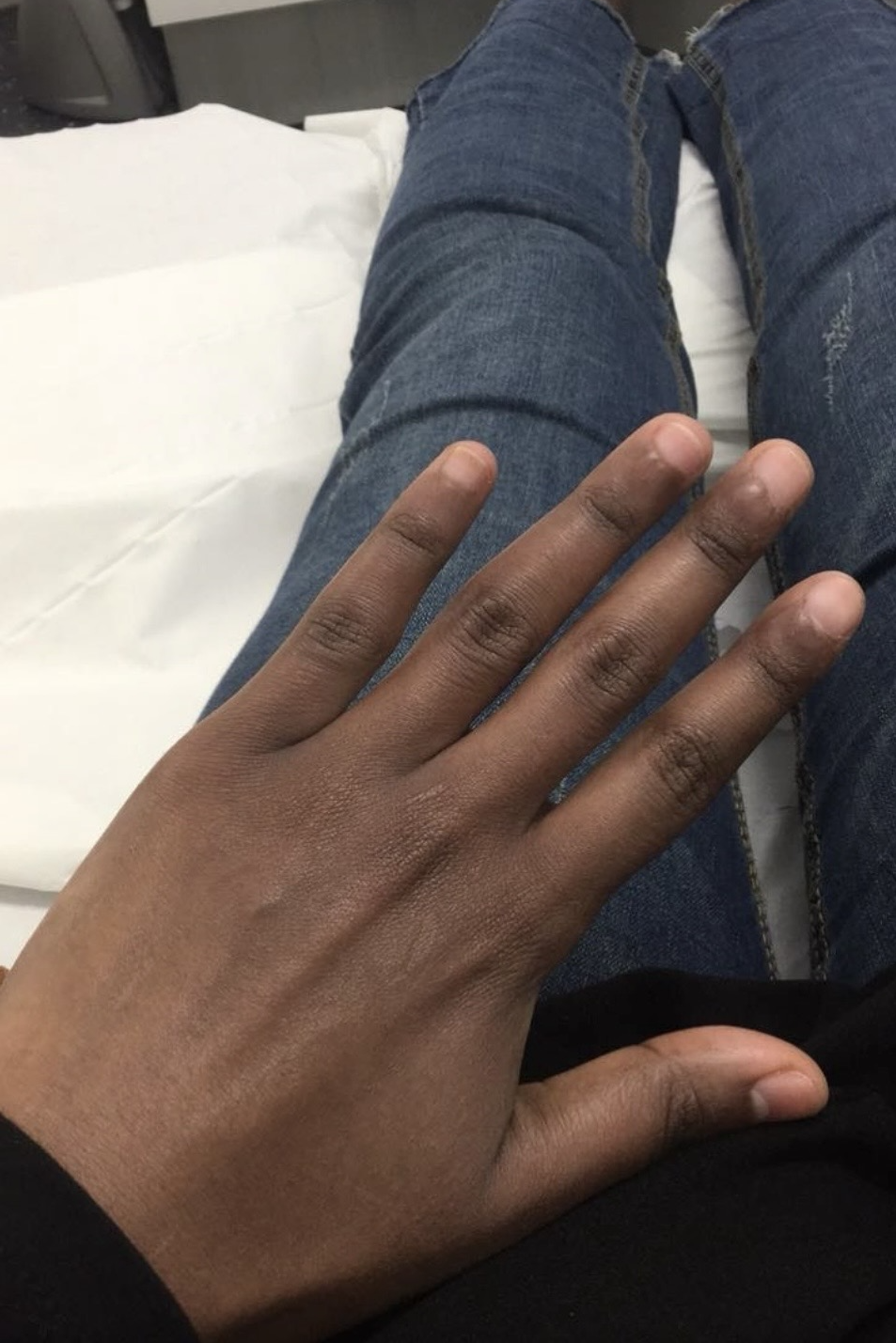 SHCGlutathione Hands and Knuckles Skin Lightening