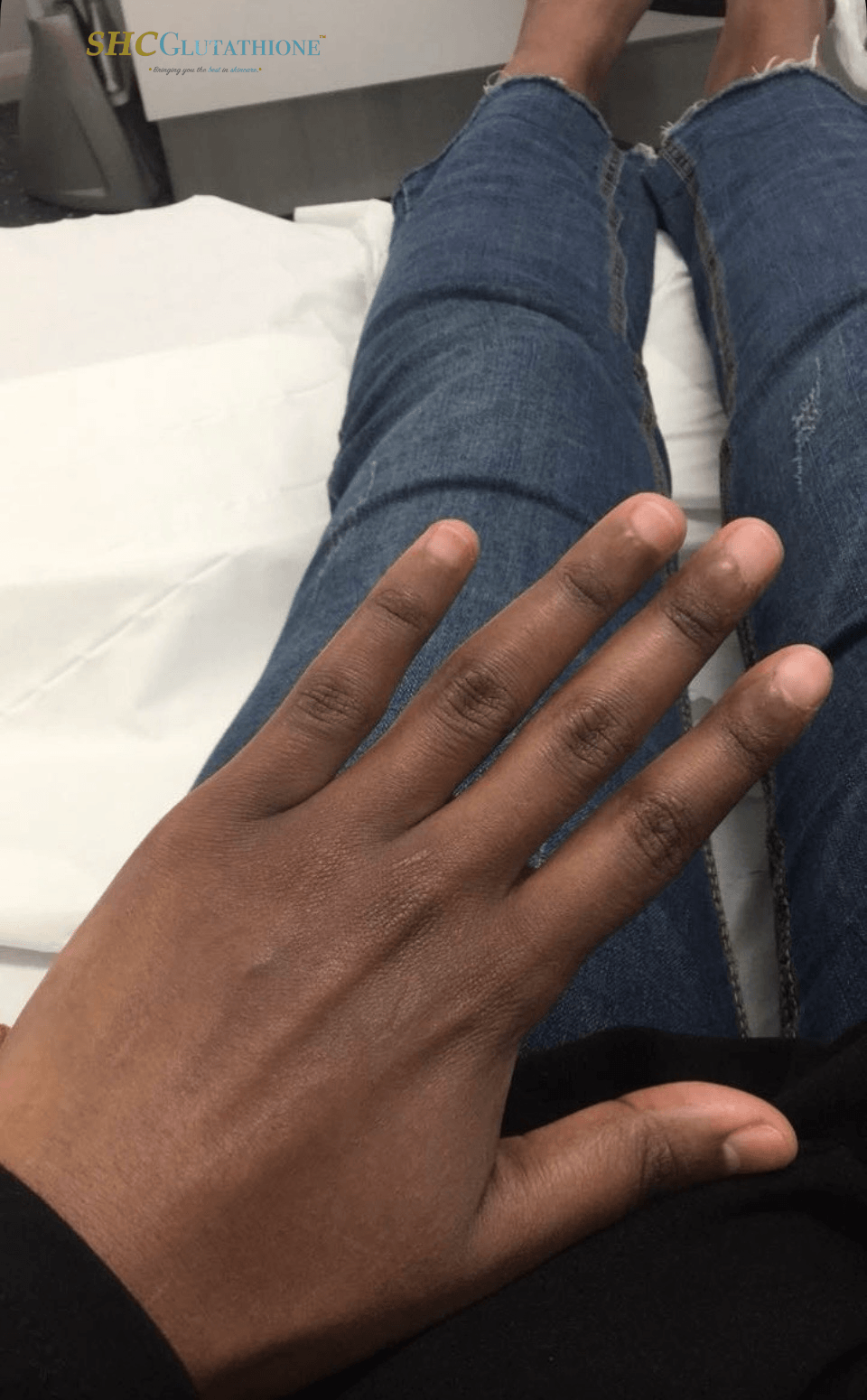 SHCGlutathione Hands and Knuckles Skin Lightening